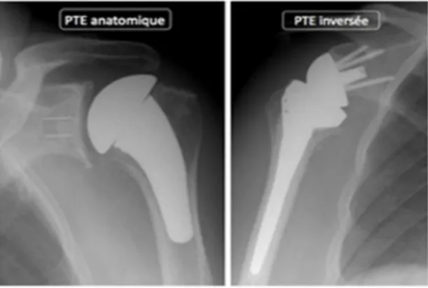 Figure 2 : Prothèse totale anatomique (gauche) et prothèse totale inversée (droite) de l’épaule 