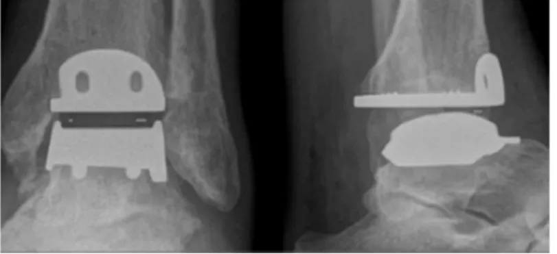 Figure 4 : Prothèse totale de cheville : vue de face (gauche) et vue de profil (droite) 