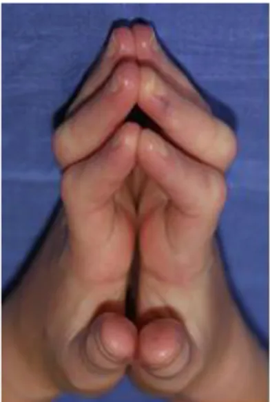 Figure 3 : Sclérodactylie  Figure 4 : Signe de la prière 