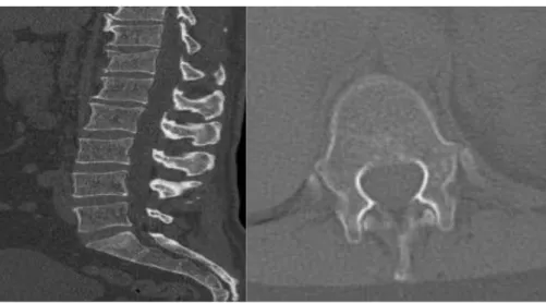 Figure 10: TDM osseux coupe sagittale + axiale La TDM en coupe osseuse confirme la fracture de T12 avec une  atteinte du plateau supérieur de T12, sans atteinte de hauteur des espaces sus et sous-jacent à la fracture, sans  modification au niveau des espac
