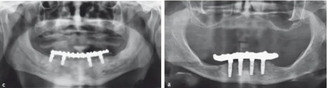 Figure 6 : Patients traités par réhabilitation implanto-prothétique sur quatre implants mandibulaires  de 5 mm versus 11,5 mm de long 