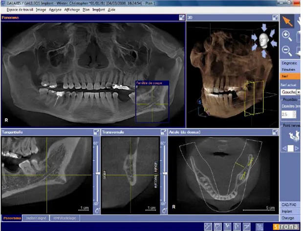 Fig.  61.  Capture  d’écran  du  logiciel  GALAXIS®  possédant  l’extension  GALILEOS  Implant® 