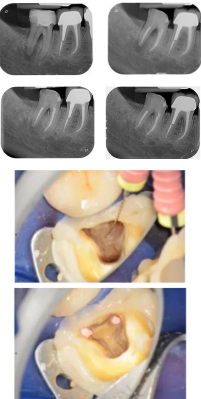 Figure 2 : Cas clinique d’une lésion endo-parodontale sur la deuxième molaire mandibulaire droite  avec la mise en évidence d’un canal de furcation à l’origine de la lésion osseuse inter-radiculaire   De gauche à droite, les vues radiographiques pré-opérat