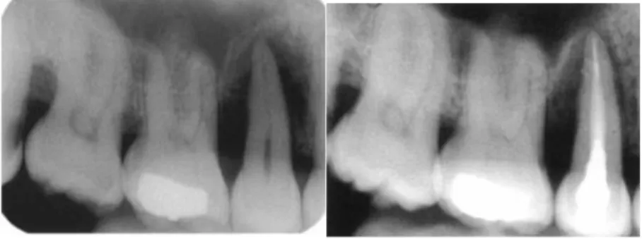 Figure 5 : Vues radiographiques le jour du premier rendez-vous (à gauche) et 4 mois après le  traitement endodontique (à droite) sans chirurgie parodontale 