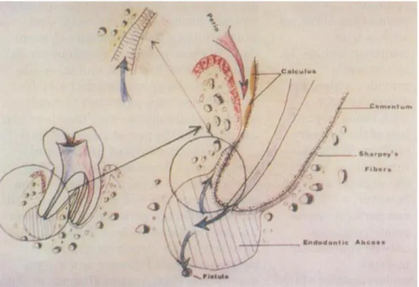 Figure 6 : Schématisation d’une parodontite rétrograde 
