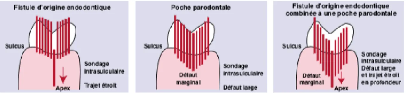 Figure 7 : Schématisation du test du sondage parodontal visant à différencier une fistule d’origine  endodontique, un défaut purement parodontal et une lésion mixte endo-parodontale 