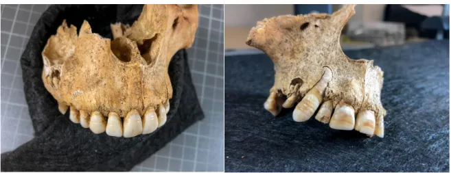 Figure 8 et 9 : Individus avec de nombreuses dents atteintes d’hypoplasie linéaire de l’émail, 