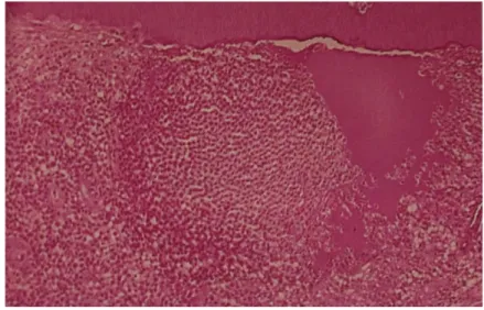 Figure 10 : Coupe histologique d’une pulpe en pulpite irréversible. 