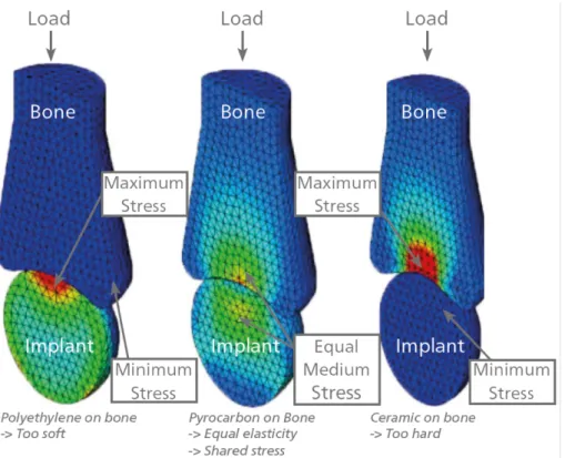 Figure 3 réaction os / implant en fonction de la rigidité 