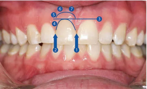 Figure 15 : Visualisation clinique du Pink Esthetic Score (Fürhauser et al. 2005). 