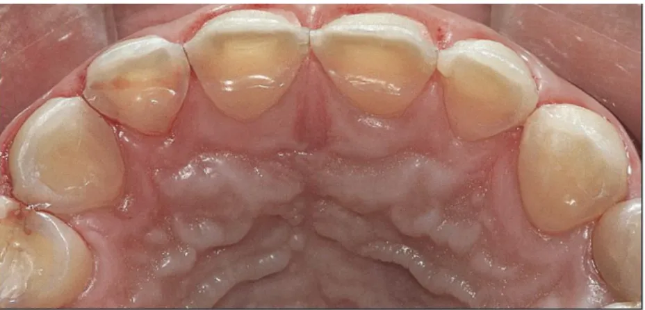 Figure 2 : Lésions cervicales non carieuses sur la face palatine des dents maxillaires antérieures chez  un patient de 45 ans présentant un reflux gastro-œsophagien non traité