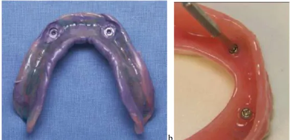 Figure 1 : Sur empreinte (a)et solidarisation des parties femelles au laboratoire(b)   (Rignon -Bret