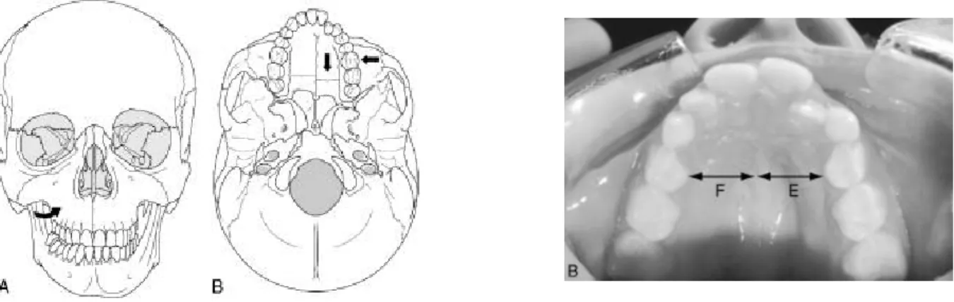 Figure 2 extension traumatique du maxillaire d’après Ricard 