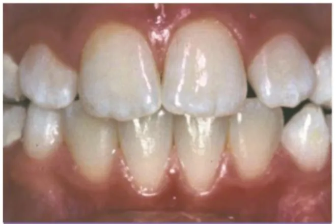 Figure 4 : Radiographie de canines retenus avec mauvais pronostic 