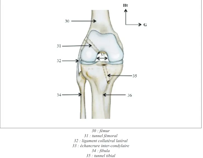 Figure 3: Vue antérieure du genou droit après réalisation des tunnels 
