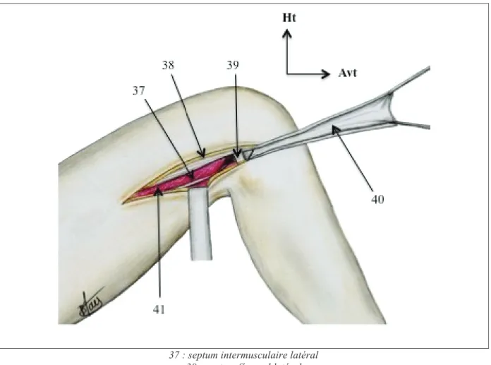 Figure 7: Préparation du transplant (vue latérale du genou droit) 