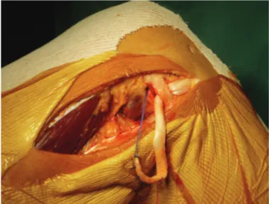 Figure 9: Positionnement du transplant sous le LCL et dans le tunnel fémoral (genou  droit) 