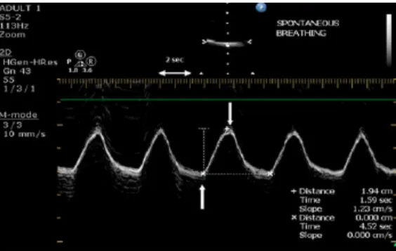 Figure 4: Mesure de la course diaphragmatique en mode M in Sonographic evaluation of   the diaphragm in critically ill patients