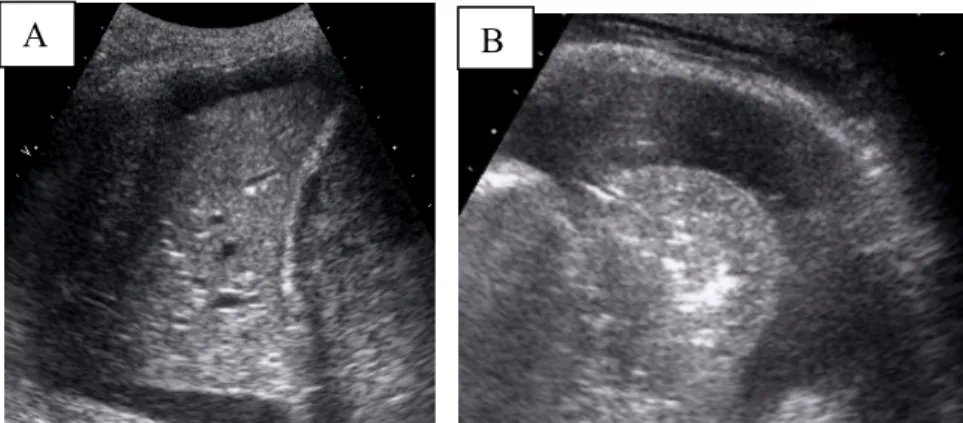 Figure 5: A = Bronchogramme liquidien B = Bronchogramme aérien 