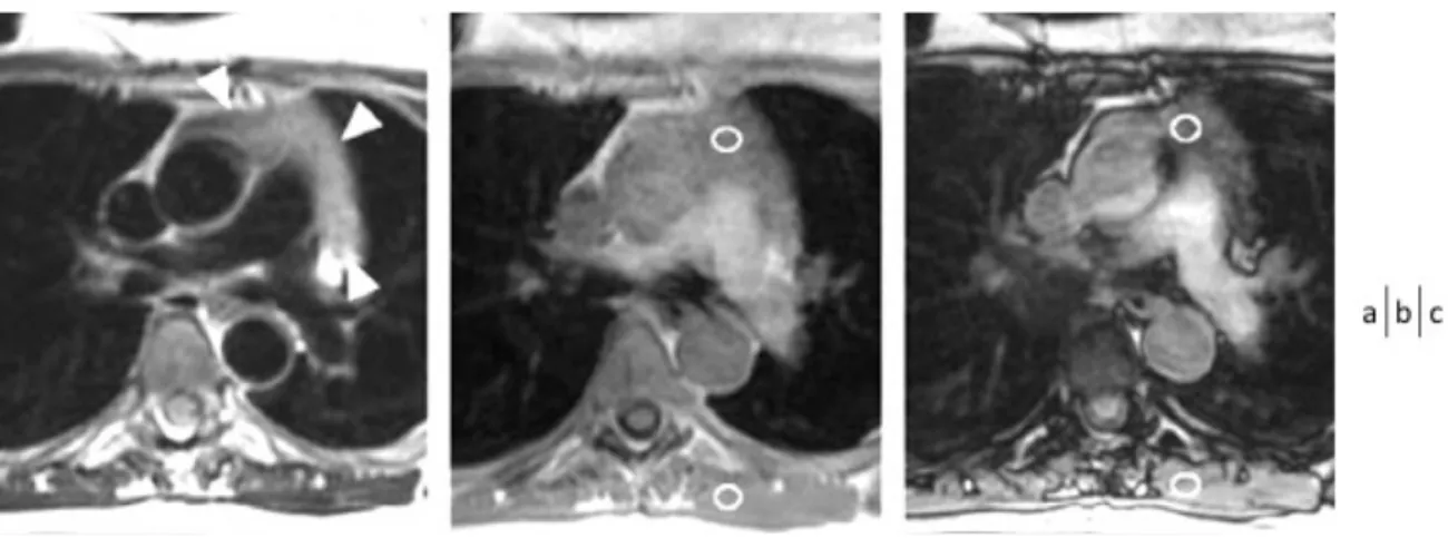 Figure 6 : Rebond thymique typique chez une patiente âgée de 45 ans, 5 mois après la fin de la chimiothérapie  pour adénocarcinome ovarien