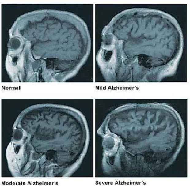 Figure 1.2: The figure for brain atrophy at four stages of AD pathology. Figure from Mayo fondation 1