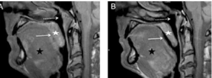 Figure 11 : Aspects IRM avant et après traitement des voies aériennes supérieures chez un patient  acromégale