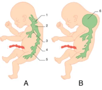 Figure 5 : système lymphatique normal (A) et en cas de ML (B) 