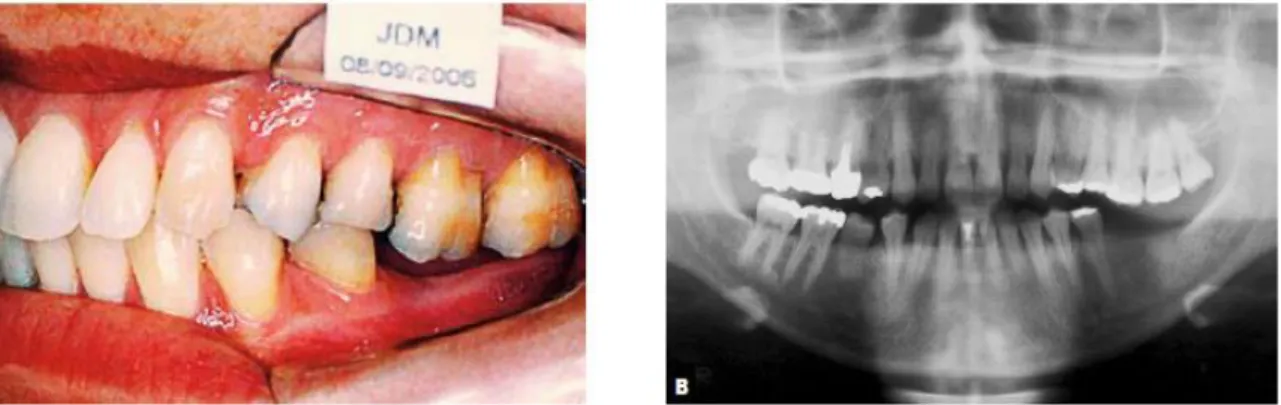 Figure 24 : Photographie et panoramique pré-orthodontique montrant l'extrusion sévère de 26 et  27, l'irrégularité du plan d'occlusion et la présence de 28 (Oliveira et al