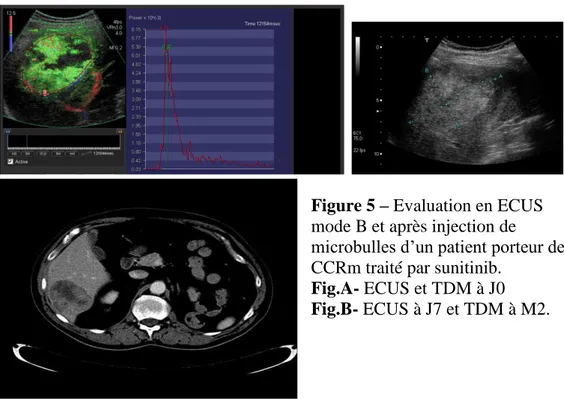 Figure 5 – Evaluation en ECUS  mode B et après injection de  microbulles d’un patient porteur de  CCRm traité par sunitinib