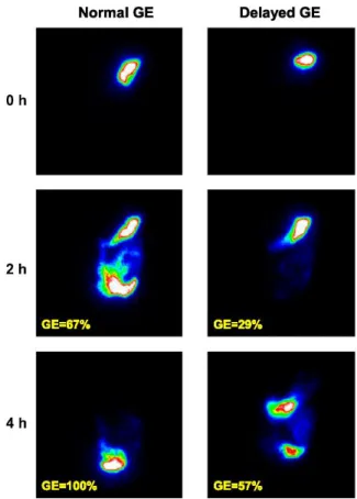 figure 8. Courbe de vidange gastrique scintigraphique chez un sujet normal, un sujet diabétique  asymptomatique et deux patients présentant une gastroparésie diabétique