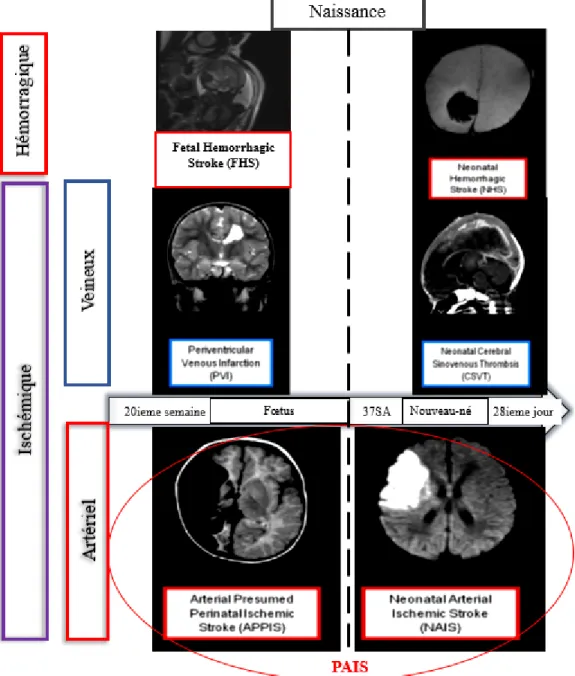 Figure 1 : Classification des AVC dans la période périnatale  D’après « Life after perinatal stroke », Kirton et al, 2013 