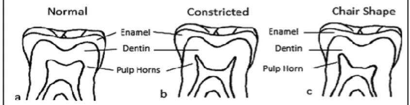 Figure  6  : Diagramme  des  différentes  formes  de  chambre  pulpaire  pour  une  molaire  permanente, a) normal : les deux cornes pulpaires sont égales, b) étroites : les deux cornes  pulpaires sont hautes et étroites, c) forme de chaise : les cornes pu