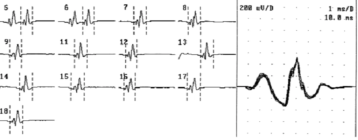 Figure 15 : Fasciculations stables. A gauche : décharges consécutives sans changement de  morphologie
