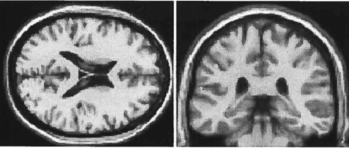 Figure 2 Correlations between poor social cognitive performance and reduced grey matter density in the lefi superior temporal gyrus and the lefi inferior parietal lobule in first episode psychosis.