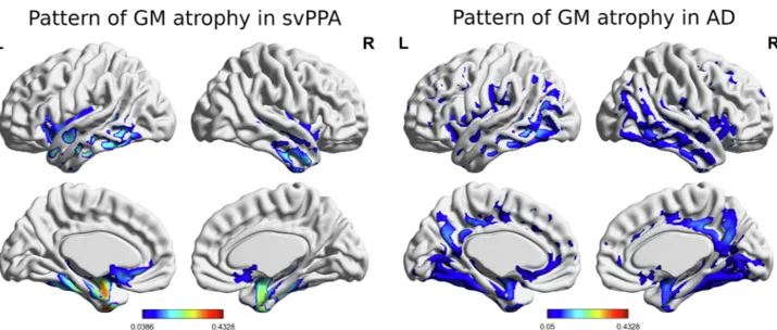 Fig. 1. Voxel-based morphometry results: pattern of gray matter atrophy in svPPA and AD displayed using BrainNet Viewer