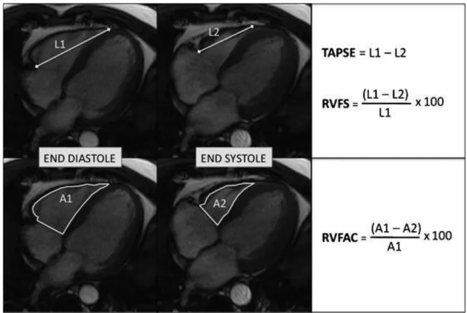 Figure 4. Méthodes de mesure semi-quantitative de la fonction ventriculaire droite sur une  coupe IRM ciné 4 cavités en télédiastole(gauche) et en télésystole(droite) d’après Caudron et  al(50)