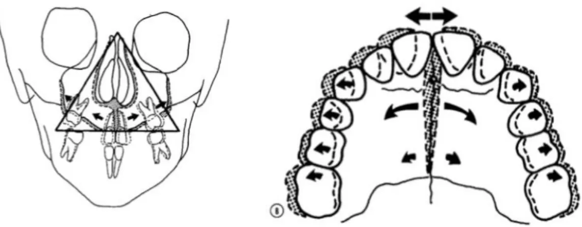 Figure 10 : Ouverture de la suture interpalatine médiane en vues occlusale et frontale 