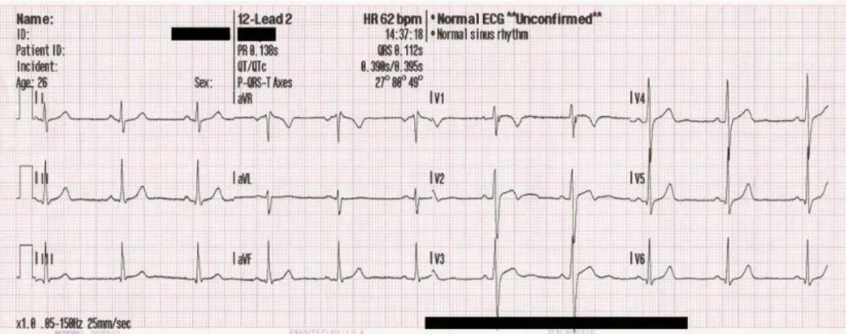 FIGURE 2.5: EXAMPLE OF AN ECG CURVE (SOURCE: ELECTROCARDIOGRAPHY. 2016, JUNE  22. IN WIKIPEDIA) 