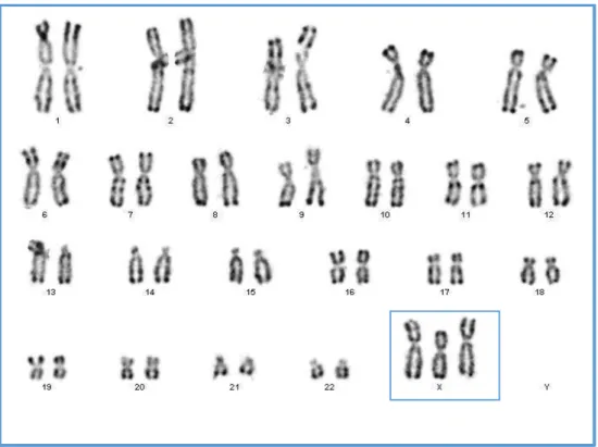 Figure 10: Caryotype de la patiente n° 2 en bande R montrant une trisomie X, les  chromosomes X sont encadrés et présents en 3 exemplaires