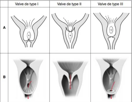 Figure 1 27  Les trois types anatomiques de valve. 