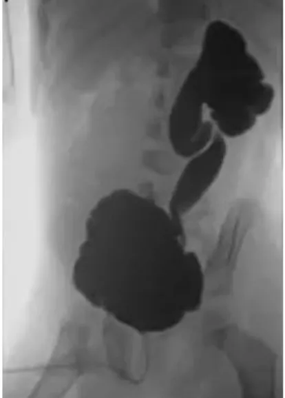 Figure 4 UCRM objectivant des VUP, une vessie de lutte et un RVU unilatéral  gauche de grade V pouvant entrer dans le cadre d’un VURD syndrome gauche chez 