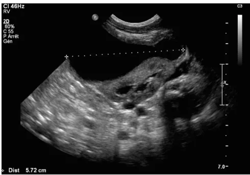 Figure 6 Echographie rénale objectivant un urinome péri-rénal extra-capsulaire  gauche chez un nouveau-né garçon porteur de VUP