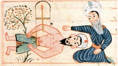 Figure 1.  &#34;Mihceme&#34; une technique de ventouses.  Source: Uzel I. Cerrahiyyetü’l Haniyye I, 1st ed