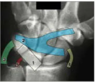 Figure V : Ligaments extrinsèques dorsaux 