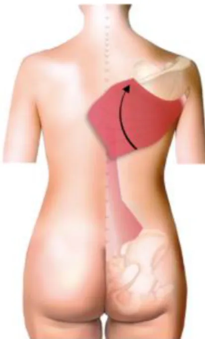 Figure 6 : mobilisation du grand dorsal à pédicule proximal 