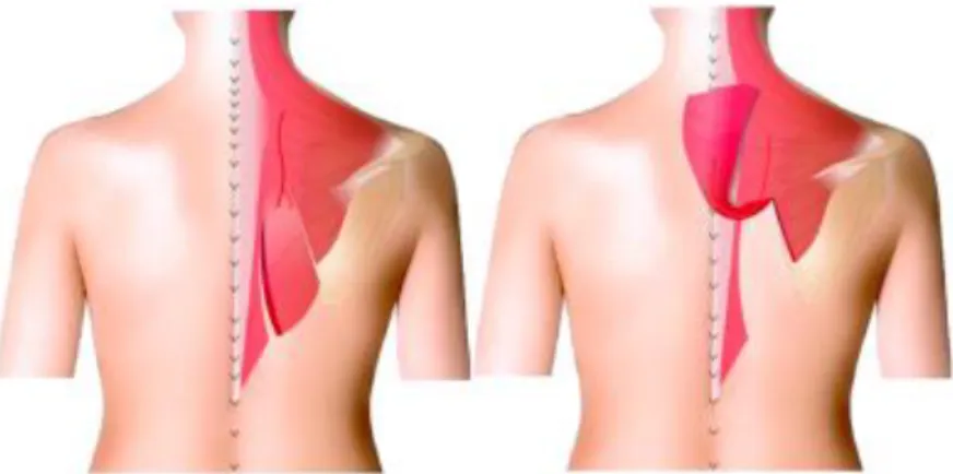 Figure 5 : mobilisation du lambeau de muscle trapèze. 