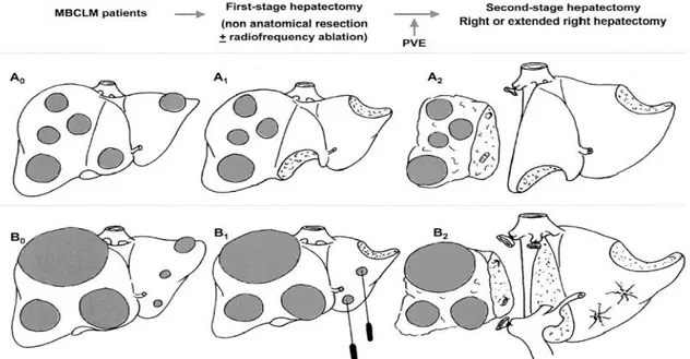 Figure 10 : Schéma d’une hépatectomie en deux temps  Source : Jaeck et al, Ann Surg 2004 