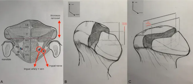 Figure 1: (a) schéma d'une section coronale de la langue passant par le dorsum; LS: 