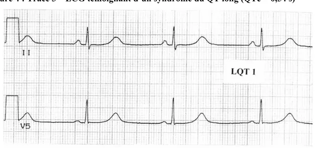 Figure 4 : Tracé 3 – ECG témoignant d’un syndrome du QT long (QTc = 0,54 s) 