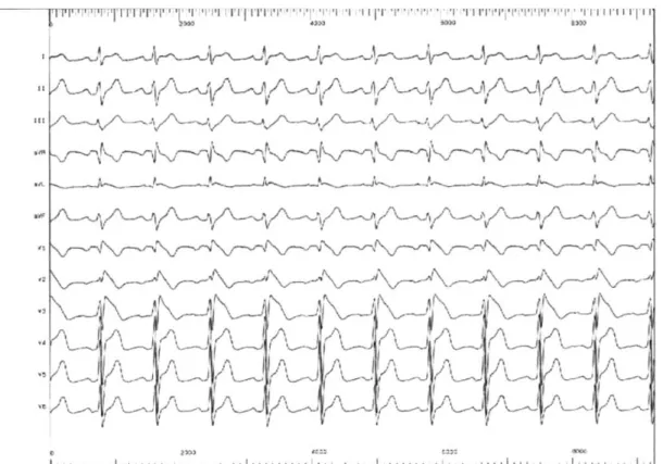 Figure  6  :  Tracé  5  –  ECG  témoignant  d’un  syndrome  de  Brugada.  Sus-décalage  du  segment ST et aspect de BBD dans les dérivations précordiales droites (V1 à V3) 